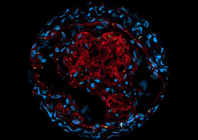 Murine Common Carotid Artery Atherothrombosis stained for Fibrinogen (red), Platelets (CD41, green) and Hoechst (Nucleus, blue). 