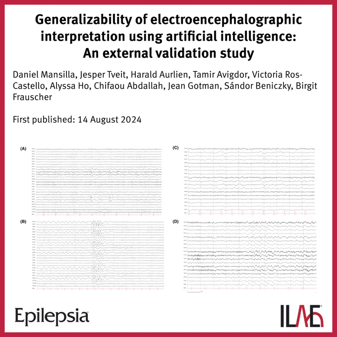 Generalizability of electroencephalographic interpretation using artificial intelligence: An external validation study
Daniel Mansilla, Jesper Tveit, Harald Aurlien, Tamir Avigdor, Victoria Ros-Castello, Alyssa Ho, Chifaou Abdallah, Jean Gotman, Sándor Beniczky, Birgit Frauscher
First published: 14 August 2024
IMAGE: Ten-second epochs from routine electroencephalograms illustrating examples for each abnormal category. (A) Focal epileptiform. Left temporal spikes in a 41-year-old patient with left temporal lobe epilepsy are shown. (B) Generalized epileptiform. Bilateral synchronous and symmetric spike-and-slow waves in a 19-year-old patient with idiopathic generalized epilepsy are shown. (C) Focal nonepileptiform. Continuous left hemisphere slowing in a 60-year-old patient with a remote left middle cerebral artery stroke is shown. (D) Diffuse nonepileptiform. Continuous background slowing in a 58-year-old patient with post-liver transplant metabolic encephalopathy is shown. High-pass fi