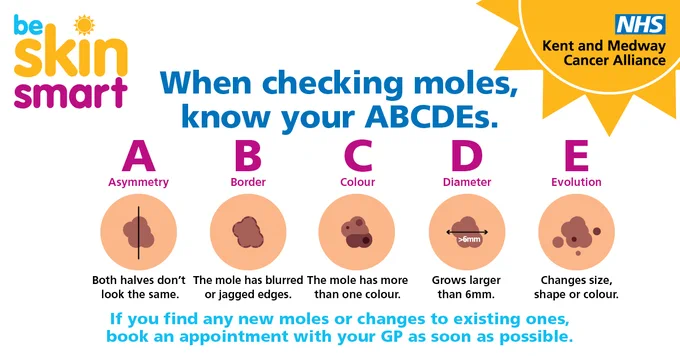 Five images of different types of moles to check on your skin. Text reads: When checking moles, know your ABCDEs.