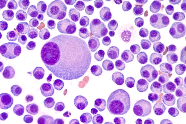 Multiple myeloma cells.