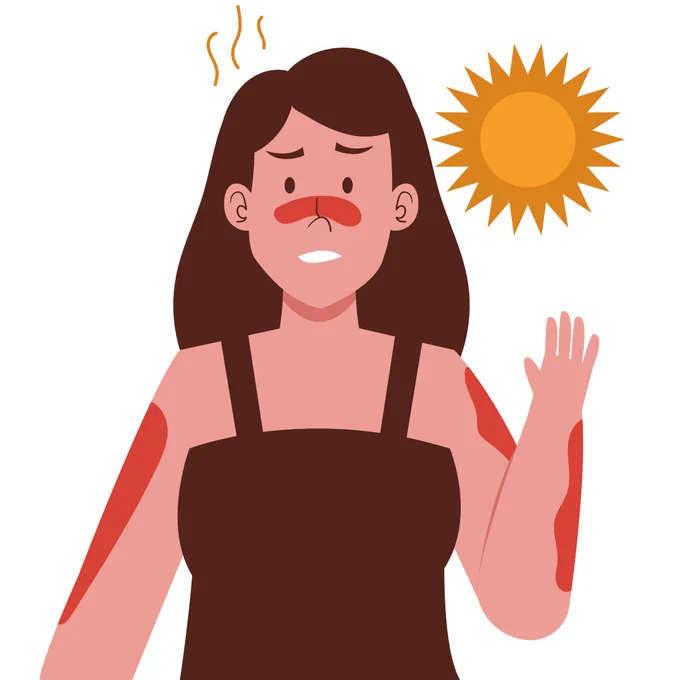 Grafik einer weiblichen Person mit Sonnenbrand.