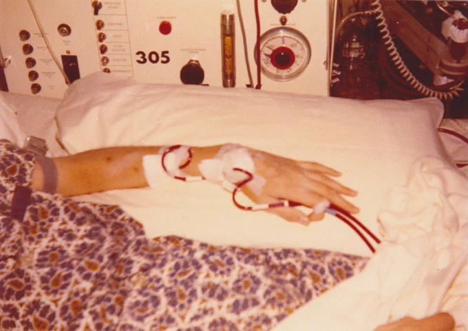 A 70's photograph of Mike receiving dialysis treatment, with visible machinery and tubes connected to their arm filtering blood, in a hospital setting.