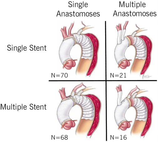 Computed tomography and magnetic resonance imaging morphologic comparison identifies aortic phenotypes for early differentiation.