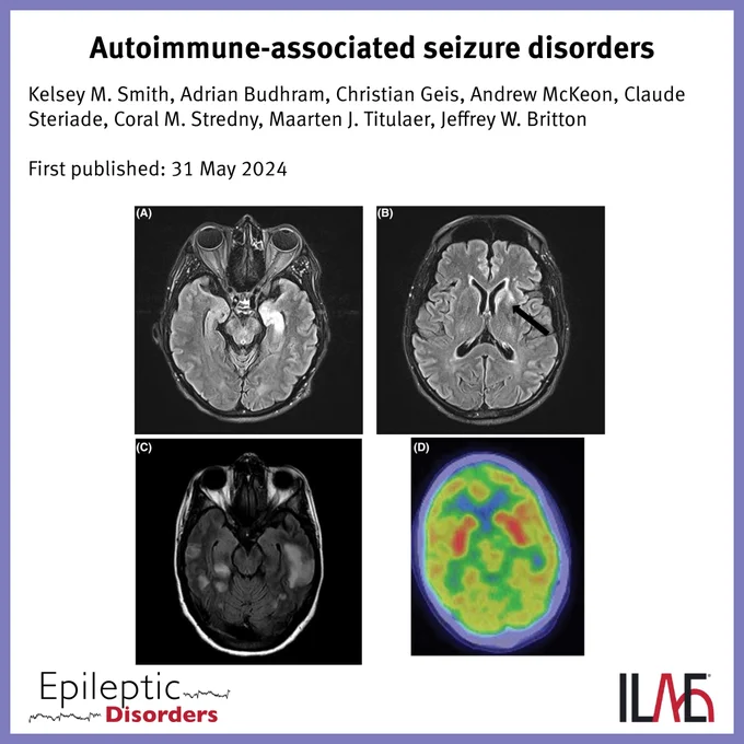 Autoimmune-associated seizure disorders
Kelsey M. Smith, Adrian Budhram, Christian Geis, Andrew McKeon, Claude Steriade, Coral M. Stredny, Maarten J. Titulaer, Jeffrey W. Britton
First published: 31 May 2024

IMAGE: Imaging findings in autoimmune-associated seizure disorders. (A, B) Imaging in a patient with LGI1 encephalitis shows T2 hyperintensity in the left>right mesial temporal lobe (A) and the left putamen and caudate (B, black arrow). (C) Imaging in a patient with GABAAR encephalitis showing multifocal T2 FLAIR hyperintensities. (D) Patchy diffuse cortical hypometabolism on FDG-PET in a patient with NMDAR encephalitis with relatively preserved basal ganglia FDG uptake

Epileptic Disorders
ILAE