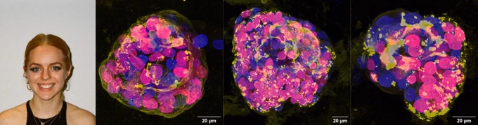 Headshot of Isobel Taylor-Hearn and 3 images of a cellular aggregate embedded in a stiff gel.