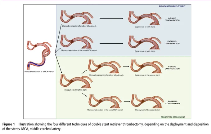 Figure 1
Illustration showing the four different techniques of double stent retriever thrombectomy, depending on the deployment and disposition of the stents. MCA, middle cerebral artery.