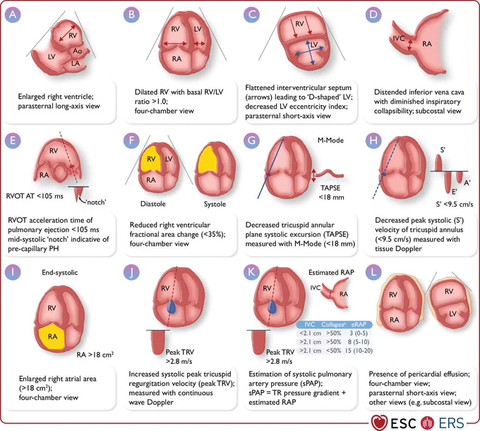 Ao, aorta; IVC, inferior vena cava; LA, left atrium; LV, left ventricle; PH, pulmonary hypertension; RA, right atrium; RAP, right atrial pressure; RV, right ventricle; RVOT AT, right ventricular outflow tract acceleration time; sPAP, systolic pulmonary artery pressure; TAPSE, tricuspid annular plane systolic excursion; TR, tricuspid regurgitation; TRV, tricuspid regurgitation velocity. a Refers to collapse on inspiration.