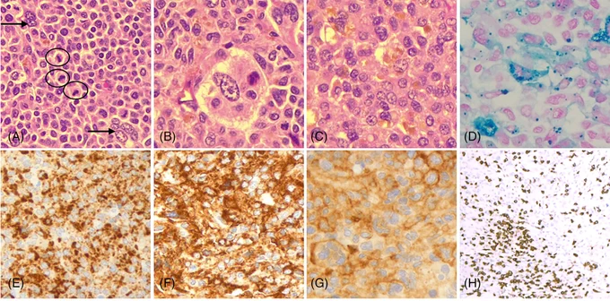 Histological examination revealed a tumor composed of cells with irregular, sometimes grooved nuclei, eosinophilic cytoplasm, and frequent mitoses (black circles), and with scattered pleomorphic multinucleated or binucleated cells (arrows) (A). Hemophagocytic activity was present in some cells (B). A brown cytoplasmic or extracellular pigment was present (C), which corresponded to hemosiderin deposits as demonstrated by Perl's immunostaining (D). Neoplastic cells were positive for CD68 (E), CD163 (F), and focally positive for CD4 (G). CD3 immunostaining demonstrated an abundant infiltrate of small lymphocytes (H).