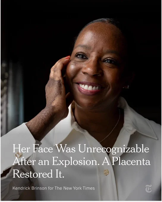 Marcella Townsend smiles as she poses for a portrait. She is wearing a white collared shirt. Text reads: "Her Face Was Unrecognizable After an Explosion. A Placenta Restored It." Photo credit: Kendrick Brinson for The New York Times