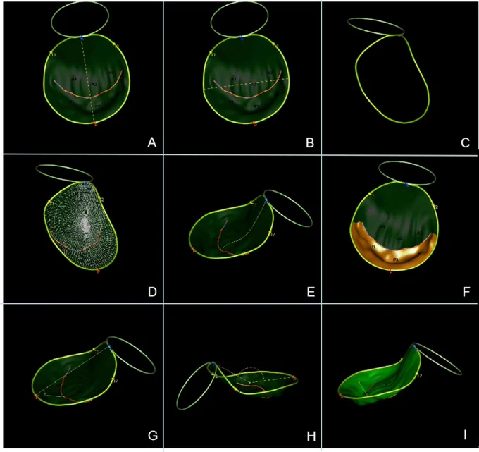 Perspectivas de la ecocardiografía transesofágica de alta velocidad en la evaluación de la geometría de la válvula mitral en pacientes con fibrilación auricular no valvular con o sin disfunción ventricular