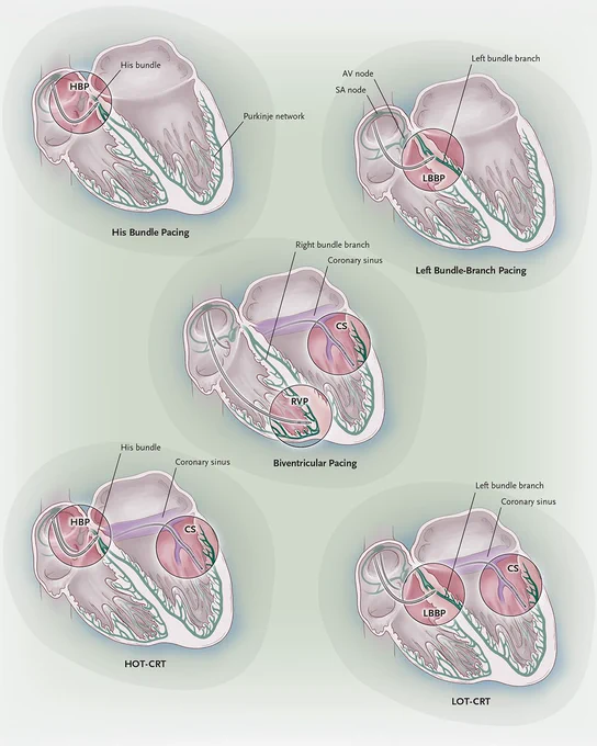 A figure showing lead configurations. 