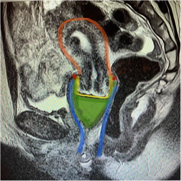 Side view MRI showing the gynaecological organs, with parts coloured. The cup is coloured in green, blue shows the vagina, the cervix is outlined in yellow and the uterus in orange. The cup is positioned around the cervix, its sides extending past the cervix. The entire cup is inside the vagina. 