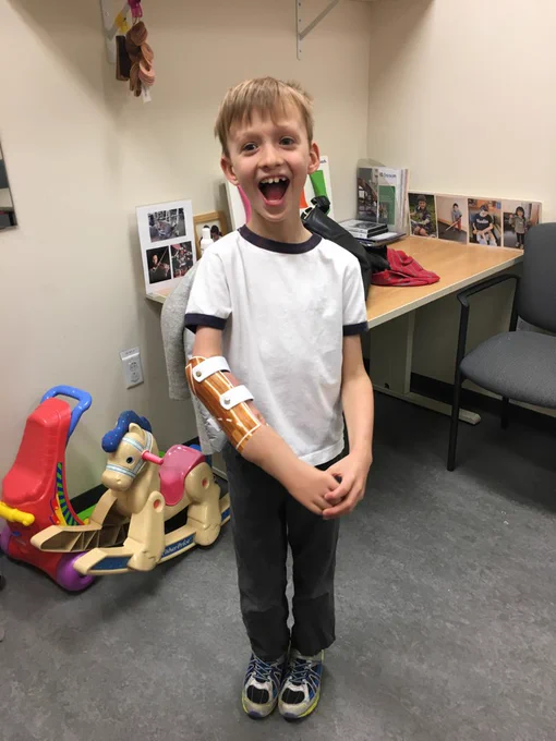 Young boy smiling trying his myo-electric prosthetic arm for the first time