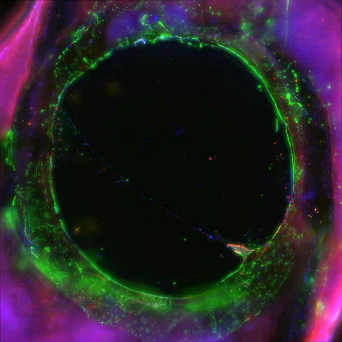 Fibrosis in human IOL