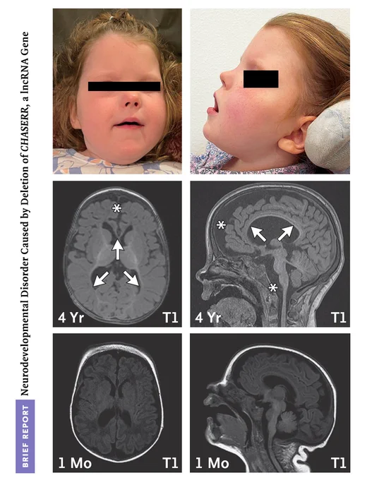 Brief Report: Neurodevelopmental Disorder Caused by Deletion of CHASERR, a lncRNA Gene
Facial features and findings on MRI of the brain in a child with CHASERR haploinsufficiency.