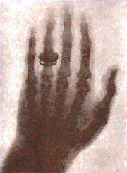 An x-ray film of a left hand with a ring on the ring finger. The bones of the hand are dark with bright white around it.