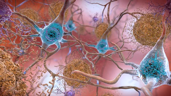 Inside a brain affected by Alzheimer’s, amyloid beta peptides form plaques (in brown) that disrupt nerve cell function, and tau protein (in blue) tangles up inside neurons, leading to synaptic breakdown and cell death. (Image: National Institute on Aging, NIH)