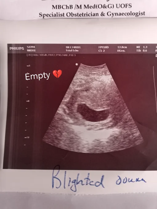 Blighted Ovum Pregnancy