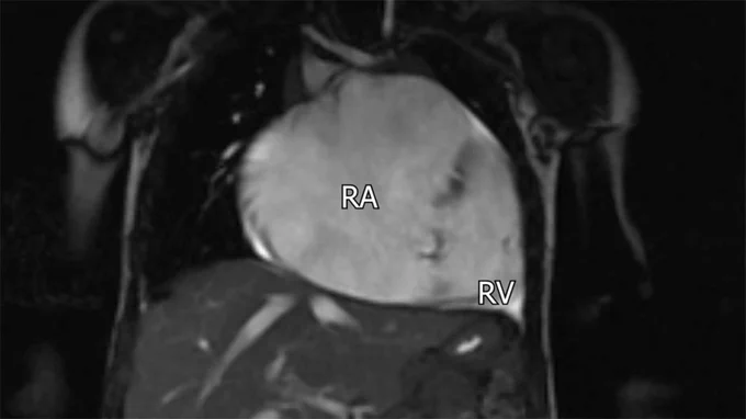 Preoperative cardiac magnetic resonance imaging showing the giant right atrium.