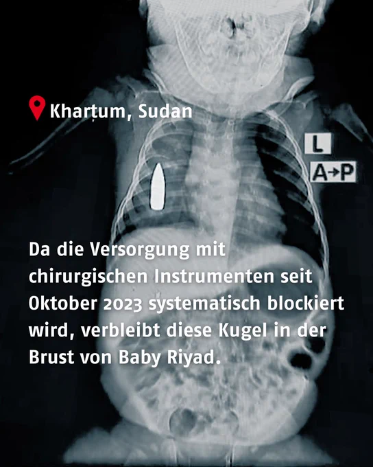 Das Bild zeigt das Röntgenbild von Baby Riyad. Darüber steht: "Da die Versorgung mit chirurgischen Instrumenten seit Oktober 2023 systematisch blockiert wird, verbleibt diese Kugel in der Brust von Baby Riyad."