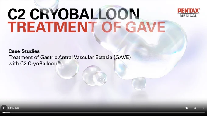 Learn more about these impactful cases and the future of GI care! Click the link to WATCH NOW: https://share.hsforms.com/1JgL6jkfqSyOQIFRWKmwDPA1aeik
