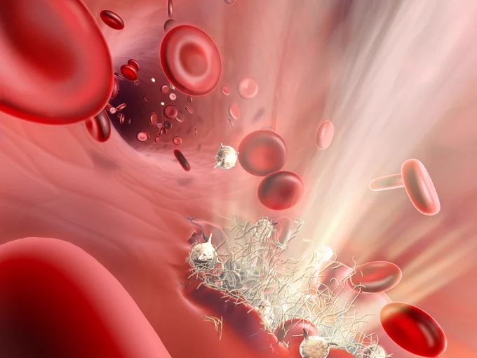 Red blood cells flow past a tear in the blood vessel, where platelets and collagen are forming a clot to close the hole and begin the healing process.