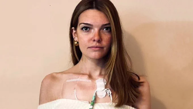 A white woman with straight light brown hair and freckles across her face, wearing an off-shoulder white top with her feeding tube on her chest.