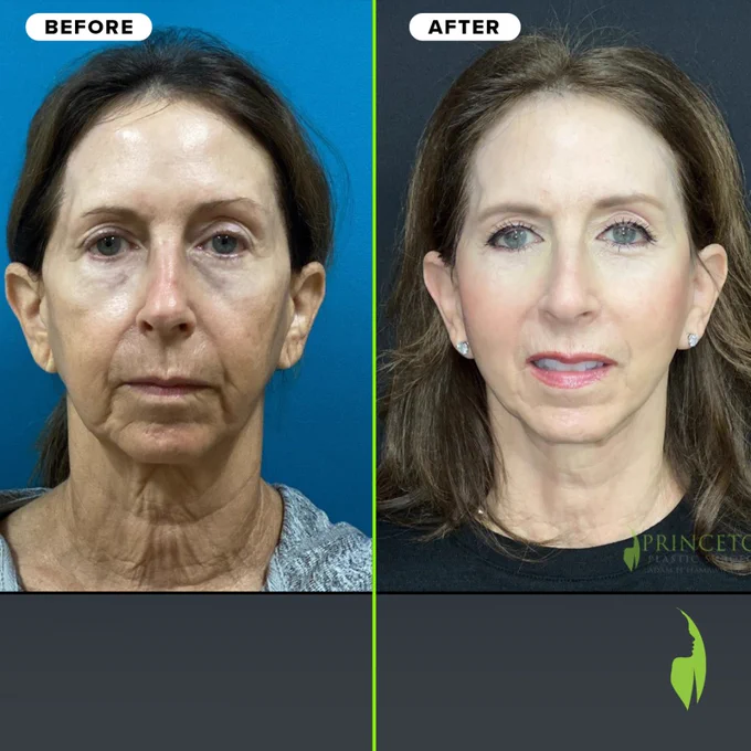 Lower Facelift & Neck Lift Transformation 
#Facelift #NeckLift #BeforeAndAfter #NaturalBeauty #FacialRejuvenation #AgingGracefully