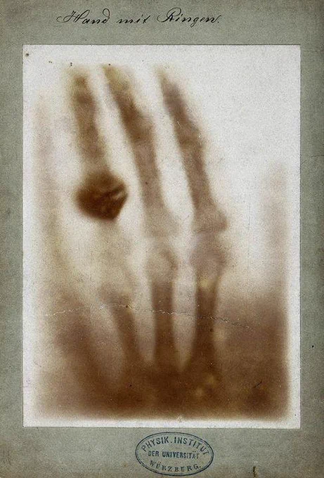 A shadowy X-ray of a hand with a ring clearly visible