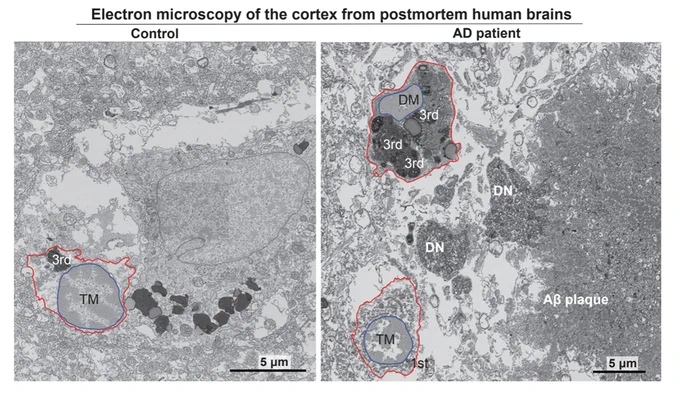 Electron micrographs show typical microglia in the prefrontal cortex of a 92-year-old healthy female (left) and dark microglia a 91-year-old female patient with Alzheimer’s disease (right).