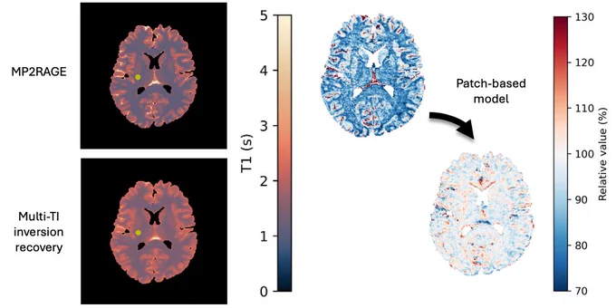 On the left are two MRIs of the brain showing different quantitative T1 values using two methods: MP2RAGE and multi-TI inversion recovery. On the right are two images showing the relative value between the two. The second image shows a major improvement in relative value after correction with a patch-based model.
