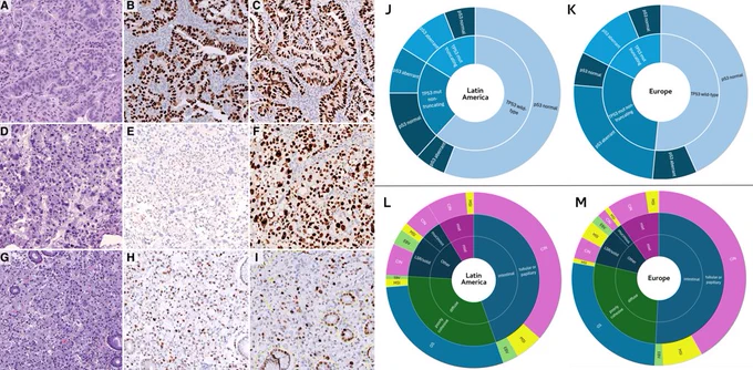 A–I IHC patterns of p53 and Ki67 expression. J–K:
Distribution of cases according to TP53 mutational status (inner
ring) and p53 IHC pattern (external ring) in Latin
America (J) and Europe (K). L, M Correlation between histological
Lauren’s classification (inner ring), WHO classification (middle
ring) and the molecular surrogate immunohistochemical classification
(external ring) in Latin America (L) and Europe (M)