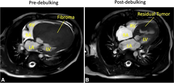 Before (A) and after (B) ventricular fibroma debulking.