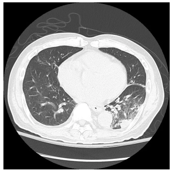 CT of L. cardiaca pneumonia in a 73-year-old man showing consolidative and ground-glass opacities in the left lower lobe and ground-glass appearance and bronchiectasis in the other lobes.