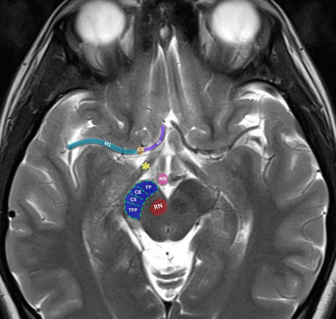 Image annotation: Raisa Amiruddin and Nikolay Yordanov

Source of the native MRI image: Abidin M, Normal MRI Brain. Case study, Radiopaedia.org (Accessed on 18 Nov 2024) https://doi.org/10.53347/rID-153576