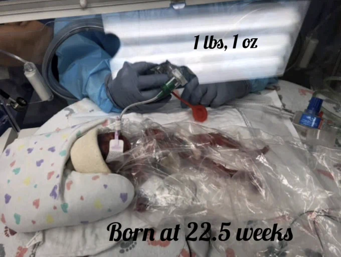 A healthcare professional in gloves cares for a premature newborn, weighing 1 pound and 1 ounce, born at 22.5 weeks, in a hospital neonatal intensive care unit. The infant is inside an incubator covered with a clear plastic wrap and surrounded by medical equipment.
