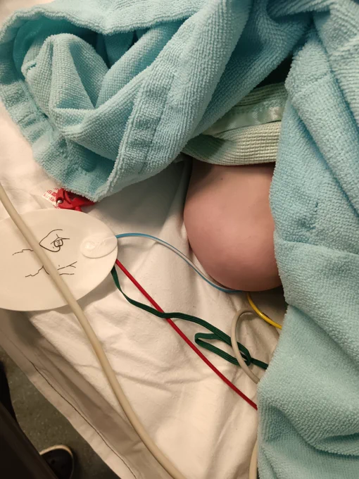 Knee of child pokes out from under a hospital blanket. Wires from ECG and a defib pad are visible 