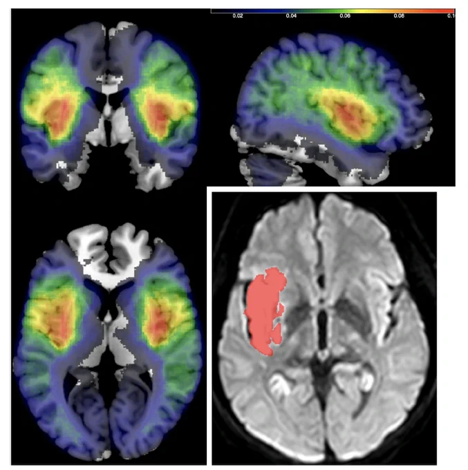 Demo image. MRIcron introduced improved drawing tools to map lesions on individual participants (inset on right, sub-09) and create lesion incidence maps. The multicolored incidence map overlay shows the fractional incidence (thresholded for blue at 1% and red at 10%) for 1449 individuals. Both images from the Stroke Outcome Optimization Project (SOOP)