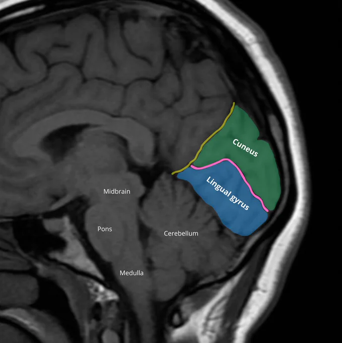 Image annotation: Raisa Amiruddin and Nikolay Yordanov

Source of the native MRI image: Gaillard F Normal brain (MRI). Case study, Radiopaedia.org (Accessed on 26 Jan 2025) https://doi.org/10.53347/rID-37605

