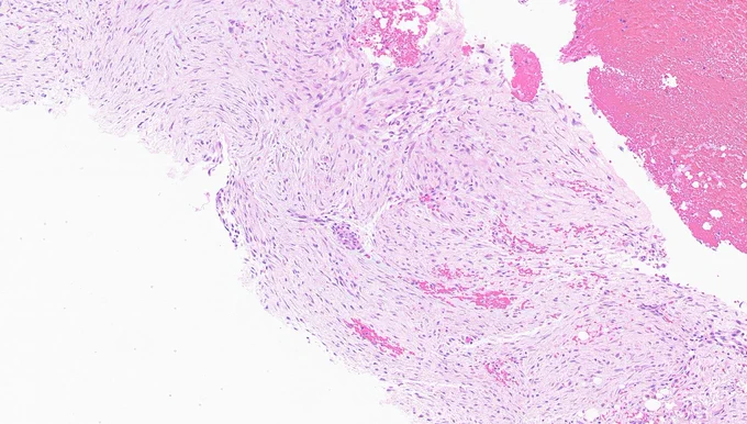 Desmoid fibromatosis with haphazard spindle cell arrangement. 