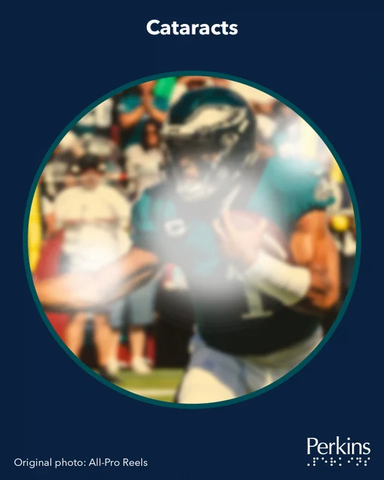 A yellow-tinted scene of a football player in a green and white #1 jersey running with a football partially obscured by blurry white spots. Text: Cataracts