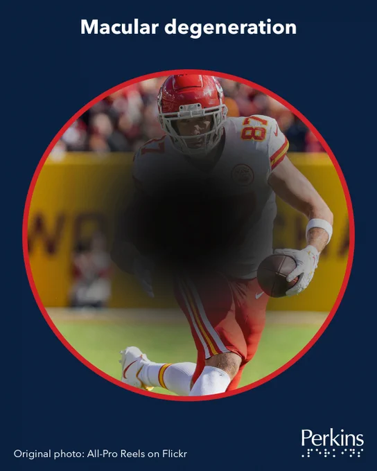 A football player in a red and white #87 jersey partially obscured by a dark cloud in the center of the scene. Text: Macular degeneration