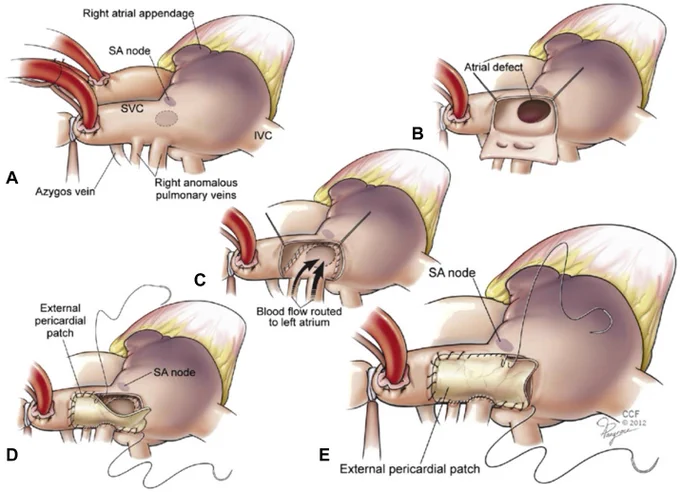 Lateral caval flap technique for repair of right-sided partial anomalous pulmonary venous connection. A, Sinus venosus defect with anomalous right upper pulmonary veins. B and C, A lateral caval flap is mobilized and sutured to reroute the anomalous venous return to the left atrium through the atrial septal defect. D and E, An autologous pericardial patch is used to close and augment the superior vena cava. Note the fine bites taken in the pulmonary veins and endocardium behind the sinoatrial node. SA, Sinoatrial node; SVC, superior vena cava; IVC, inferior vena cava.