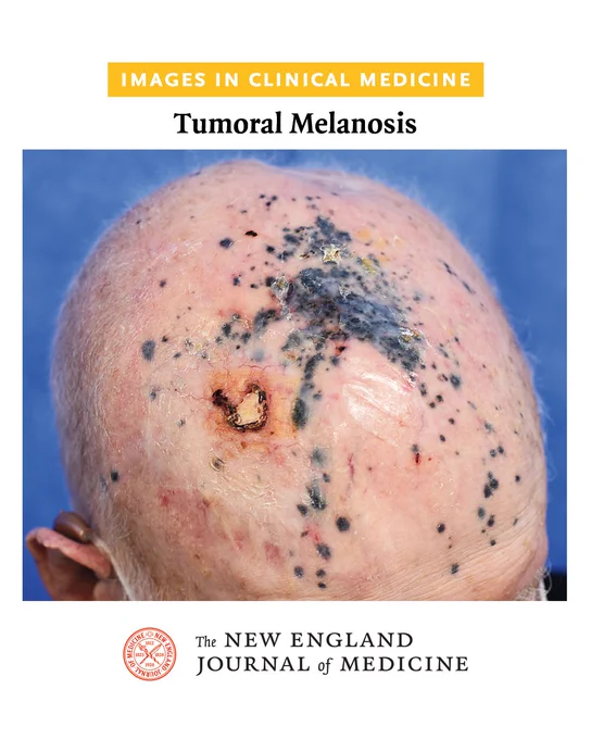 Images in Clinical Medicine 
Tumoral Melanosis 

Photo of the multiple blue-gray macules on the patient's scalp, as well as an unhealed ulcer from trauma 