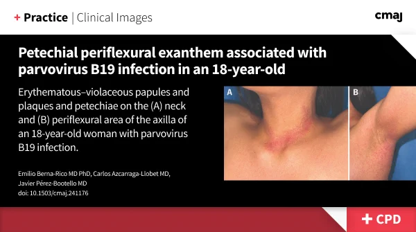 Erythematous–violaceous papules and plaques and petechiae on the (A) neck and (B) periflexural area of the axilla of an 18-year-old woman with parvovirus B19 infection.