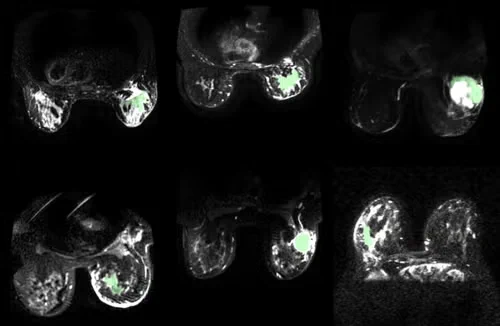 Several MRI images developed by the Waterloo research team show how cancerous tissue can "glow" in light green imaging, helping doctors better detect cancer in breast cancer.