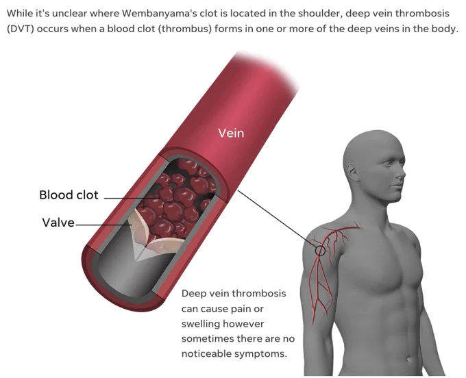 Diagram of blood clot. Text: While it's unclear where Wembanyama's clot is located in the shoulder, deep vein thrombosis (DVT) occurs when a blood clot (thrombus) forms in one or more of the deep veins in the body. Deep vein thrombosis can cause pain or swelling however sometimes there are no noticeable symptoms.