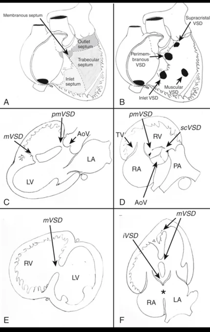 A detailed schematic of the ventricular septum and various types of ventricular septal defects (VSDs).

(A) The ventricular septum is divided into four regions: inlet, trabecular, outlet, and membranous.
(B) Different types of VSDs are shown, including perimembranous, muscular, inlet, and supracristal VSDs.
(C) Parasternal long-axis echocardiographic view illustrating a perimembranous VSD (pmVSD) below the aortic valve and a mid-muscular VSD (mVSD).
(D) Parasternal short-axis view at the aortic valve level showing a pmVSD (10 o’clock position) near the tricuspid valve and a supracristal VSD (scVSD) at 1 o’clock near the pulmonic valve.
(E) Parasternal short-axis view demonstrating a muscular VSD.
(F) Apical four-chamber view highlighting an inlet VSD (iVSD) and multiple muscular VSDs (mVSDs). A primum-type atrial septal defect (ASD) is also indicated.