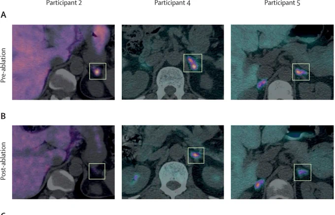 Pre-ablation (A) and post-ablation (B) axial PET-CT overlay images for representative patients. Copyright: 2024 The Author(s). Published by Elsevier Ltd. CC BY 4.0.