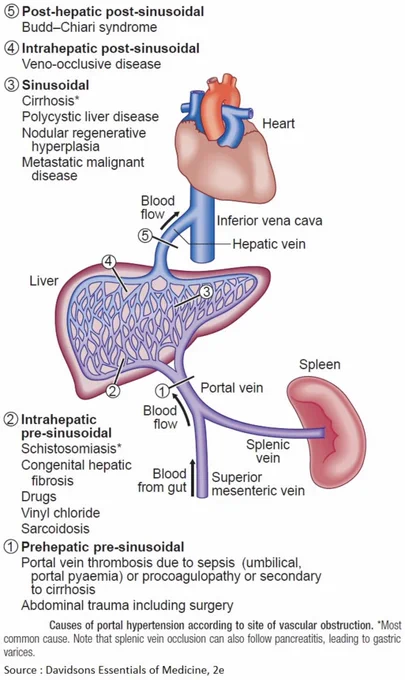 Causes of Portal Hypertension